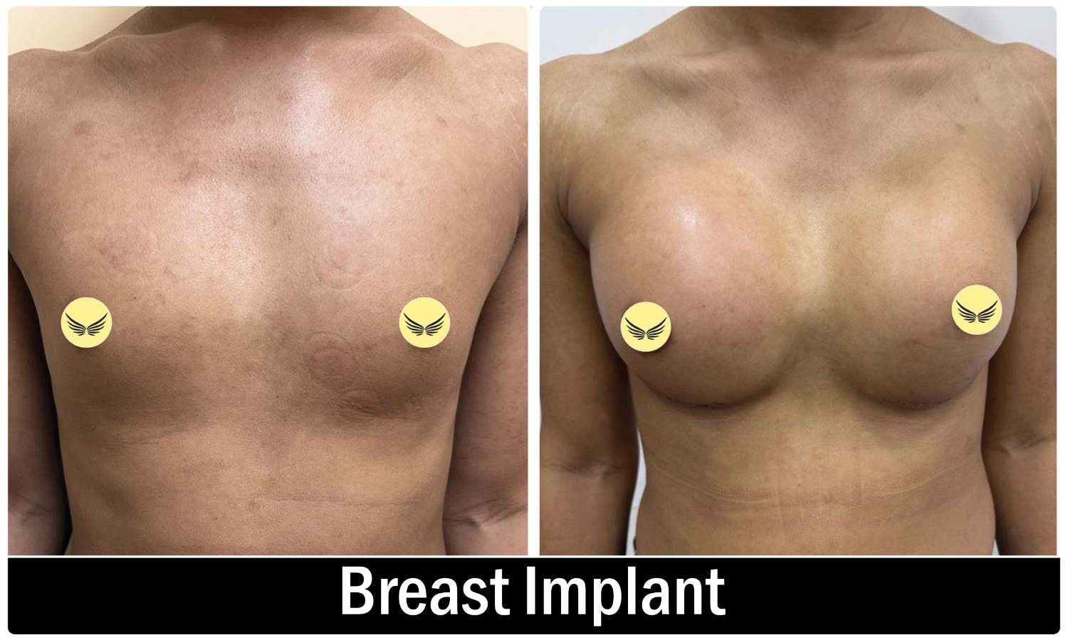 Breast surgery consultation at Symmetrica, Siliguri
